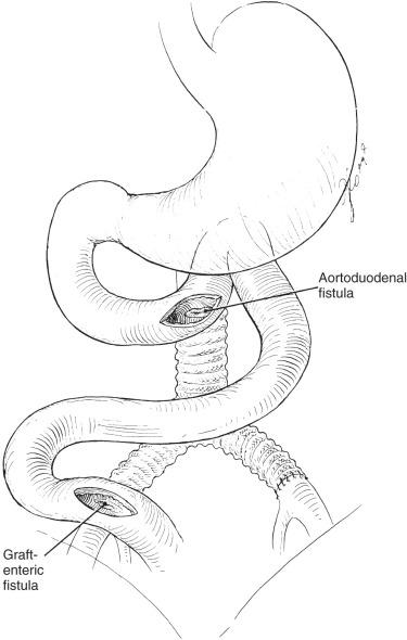 FIG 59.2, A communication may develop between the bowel lumen and the graft. Hemorrhage may be due to a direct communication between the aorta and the bowel (aortoenteric fistula) or from vessels in the bowel wall that have been eroded by the prosthetic graft (enteroparaprosthetic fistula).