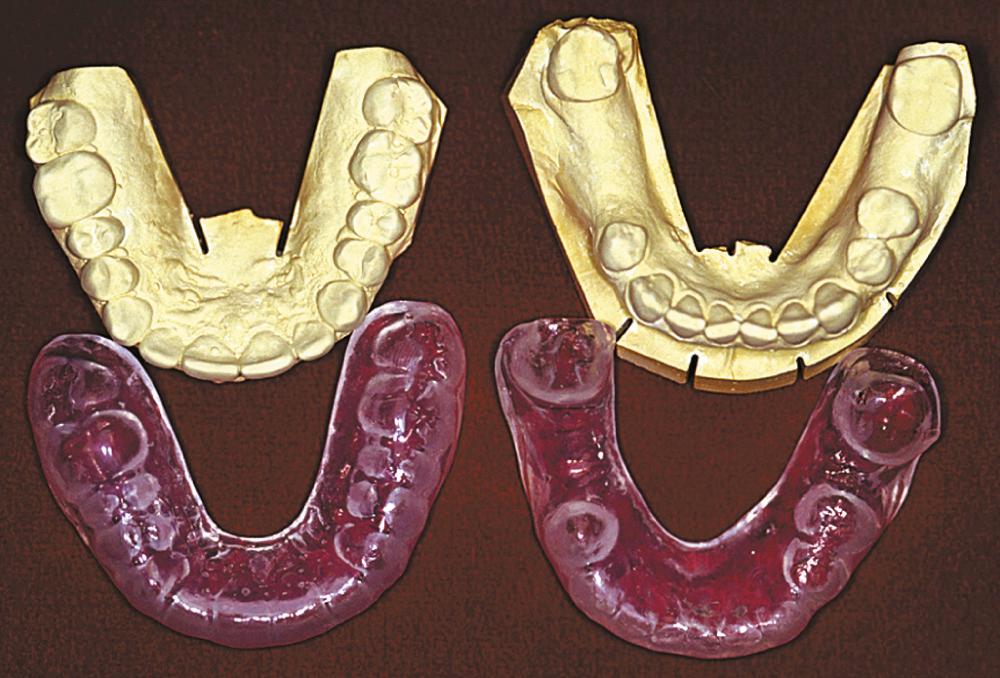 Fig. 93.1, Thermoplastic vinyl fluoride gel carriers and the models on which the gel carriers are made.