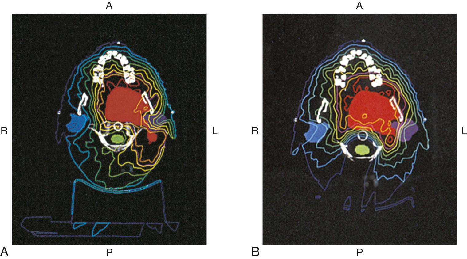 Fig. 93.11, (A) Computed tomography (CT) illustration of intensity-modulated radiation therapy (IMRT) isodose lines for a patient treated for a left tonsillar squamous cell carcinoma (SCC). The development of a second primary SCC in the area of the right maxillary palatal mucosa after IMRT necessitated a right inferior maxillectomy. The subsequent development of osteoradionecrosis (ORN) in the area of the maxillectomy is substantiated by the cumulative dose of radiation in the area of the posterior right maxilla. The axial image demonstrates dosages delivered to the dentoalveolar structures at a level midway between the crestal alveolar bone and the periapices of the right maxillary molars. (B) The patient's left tonsillar tumor bed was boosted during the administration of IMRT. The CT axial image delineates the additional dosages that were received during the boost in the area of the right posterior maxilla. The collective dose to the right posterior maxilla in the area of subsequent postoperative ORN approximated 7000 cGy and warranted a hyperbaric oxygen therapy regimen that mitigated the ORN.