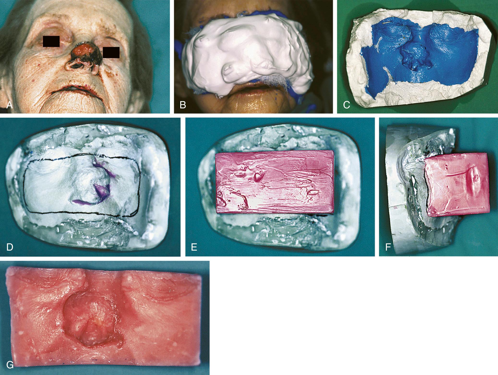 Fig. 93.2, (A) Basal cell carcinoma of the nasal bulb to be treated with external electron beam radiation therapy. (B) Facial moulage being recorded. (C) Facial moulage prepared for casting. (D) Model on which the wax bolus was fabricated. (E) Frontal view of the bolus. (F) Lateral view of the bolus. (G) Intaglio surface view of the bolus.