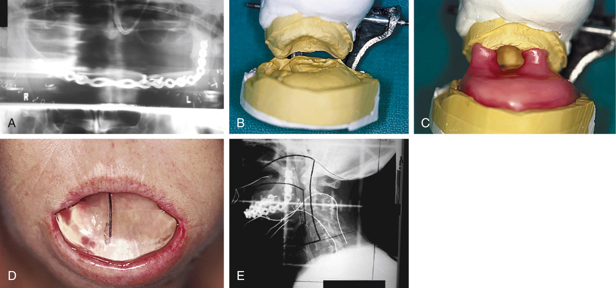 Fig. 93.3, (A) Panoramic radiograph after segmental mandibulectomy, total glossectomy, floor-of-mouth resection, and microvascular fibula free flap reconstruction for a squamous cell carcinoma. (B) Models of the maxillary and neomandibular structures articulated in relation to one another. (C) Wax pattern of the proposed positioning device before its completion. The wax pattern covers the microvascular free flap tissues in the area of the floor of the mouth once occupied by the oral tongue. Bilateral pillars engage the maxillary model to maintain a consistent maxillomandibular relationship during each radiation therapy fraction. (D) Clinical view of the anterior aspect of the polymethylmethacrylate positioning device. A segment of orthodontic wire placed within the midsagittal plane of the positioning device identifies the dorsum of the microvascular free flap structures during radiation oncology simulation and ensures its inclusion in proposed radiation therapy fields. (E) Simulation radiograph exposed with the positioning device positioned intraorally.