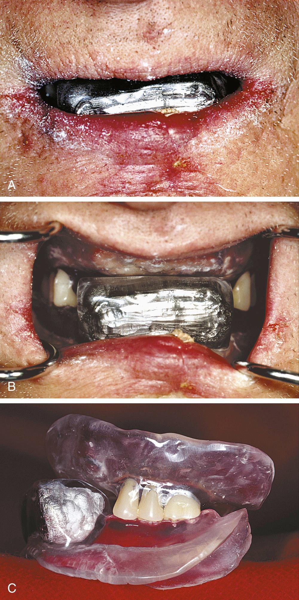 Fig. 93.4, (A) Clinical frontal view of a Lipowitz alloy–containing shielding device used during external electron beam radiation therapy for a squamous cell carcinoma of the lower lip. The device was held in its interocclusal position during fractionation and served not only to shield normal anatomy but also to anteriorly displace the labial tissues being treated from posterior structures to be spared of radiation. (B) Clinical frontal view of the shielding device with the patient's lips retracted. (C) Extraoral view of the shielding device.