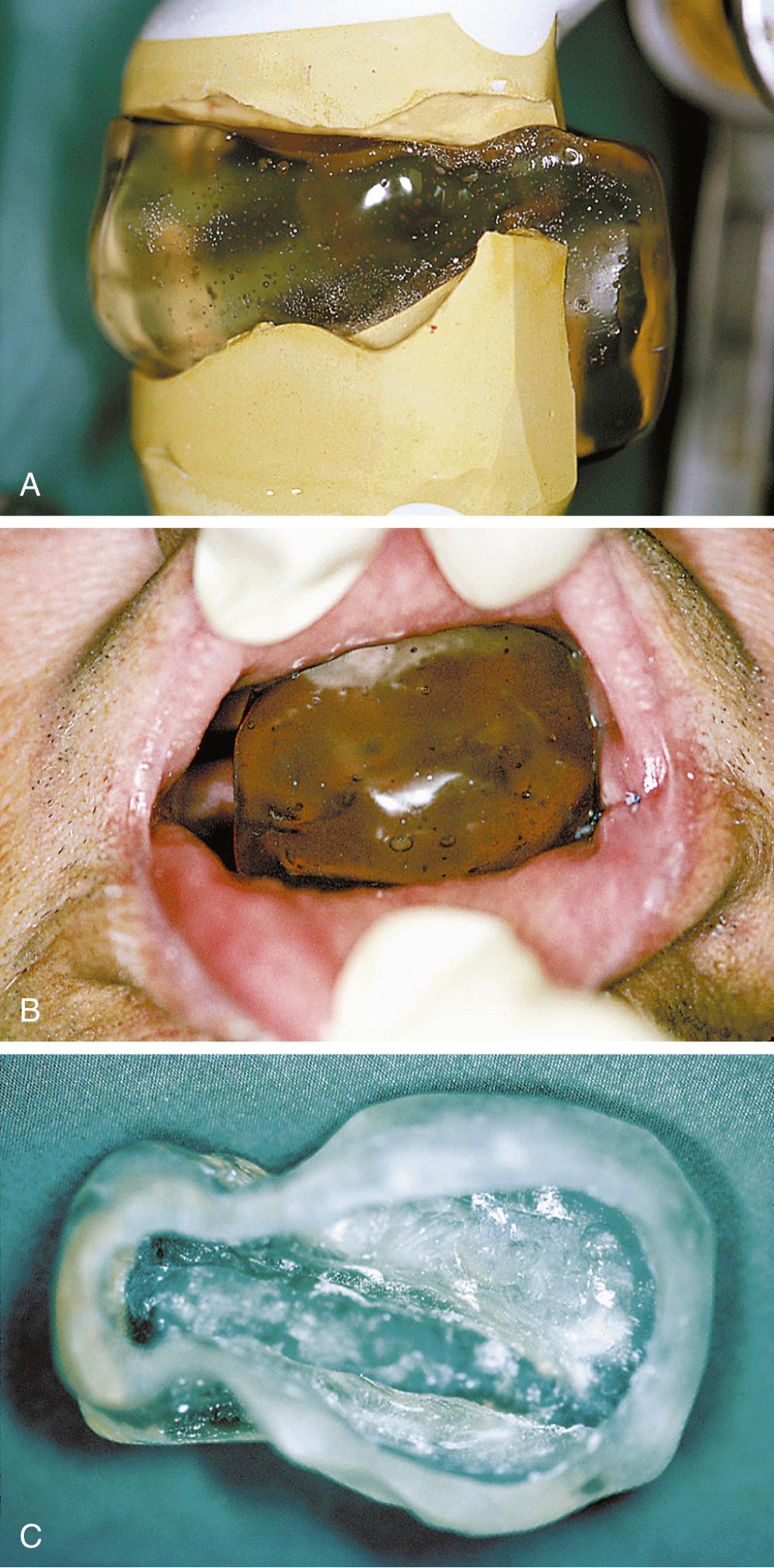 Fig. 93.5, (A) Shielding device positioned on the articulated models on which it was constructed. The device was fashioned for use during radiation therapy for a left parotid gland adenoid cystic carcinoma and extends as far into the oropharynx as the patient will allow without gagging. Lateral view demonstrates that portion of the polymethylmethacrylate intended to displace buccal tissues in an ipsilateral direction to further separate tissues to be treated from those that should not be. (B) Clinical verification of the fit of the device before it is filled with Lipowitz alloy. (C) The device is hollowed from the medial side before being loaded with the alloy.