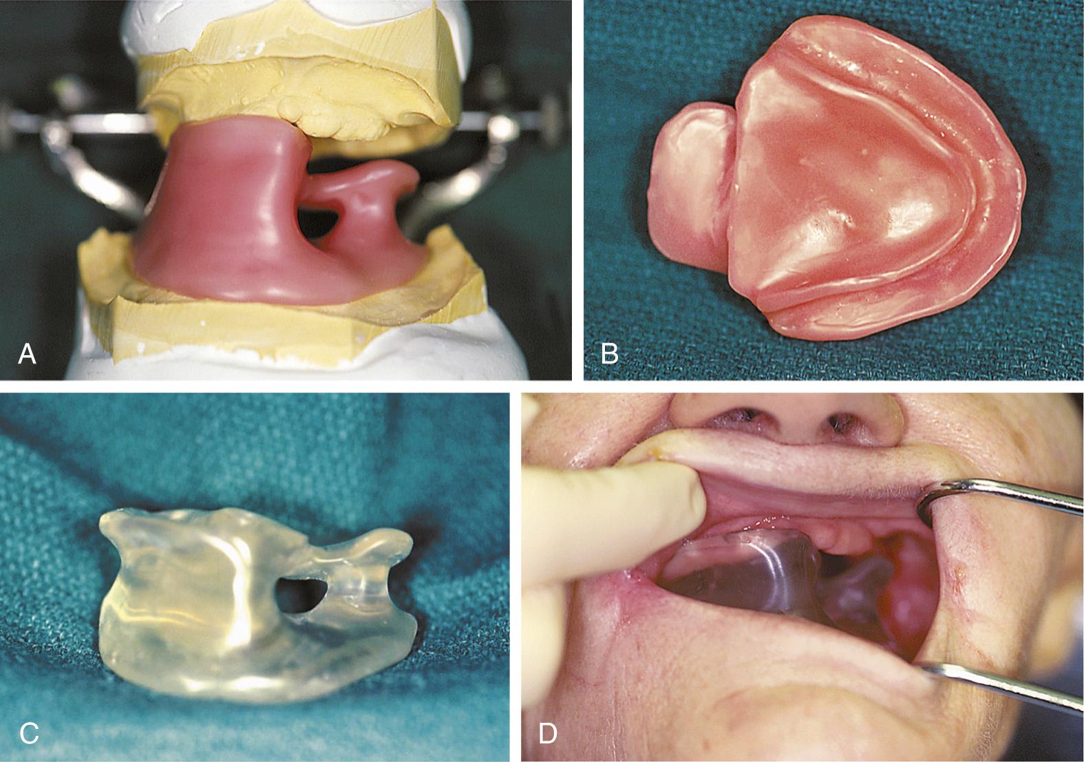 Fig. 93.6, (A) Anterior view of articulated maxillary and mandibular models and the wax pattern used to generate an intraoral device that serves to repetitively position the mandible and oral tongue; it also supports a water-filled diaphragm for use during radiation fractionation, and the diaphragm thus occludes maxillectomy defects and serves as a tissue-equivalent material. (B) Inferior view of the wax pattern demonstrates an axial shelf to inferiorly confine and exclude the oral tongue from the radiation fields. (C) Anterior view of the finished intraoral device. (D) Anterior view of the positioned intraoral device demonstrates the diaphragm-supporting shelf situated immediately inferior to the maxillectomy defect.