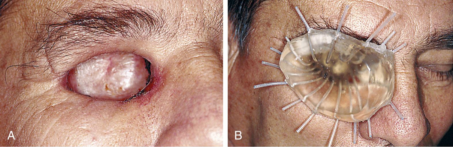 Fig. 93.7, (A) Orbital exenteration site for a patient whose positive melanoma margins necessitated postoperative brachytherapy. (B) Brachytherapy device in position demonstrates accessibility to catheters for radioisotopic seeding and treatment.