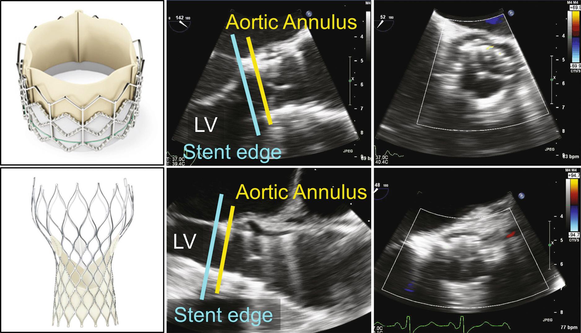 Fig. 13.4, Transcatheter aortic valve bioprosthesis.