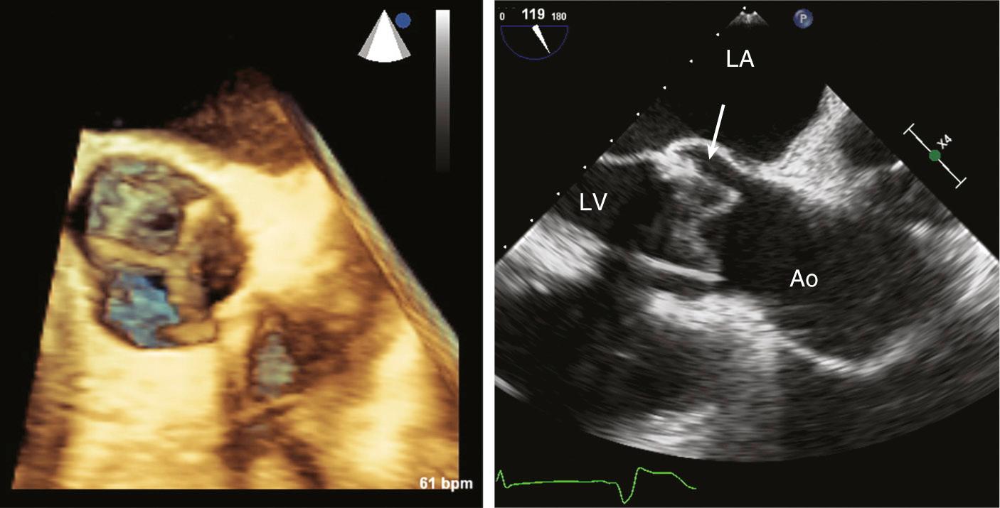 Fig. 13.8, Bioprosthetic aortic valve.