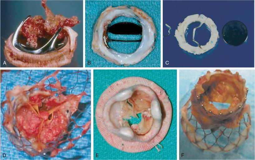 Fig. 26.3, Prosthetic Valve Complications.