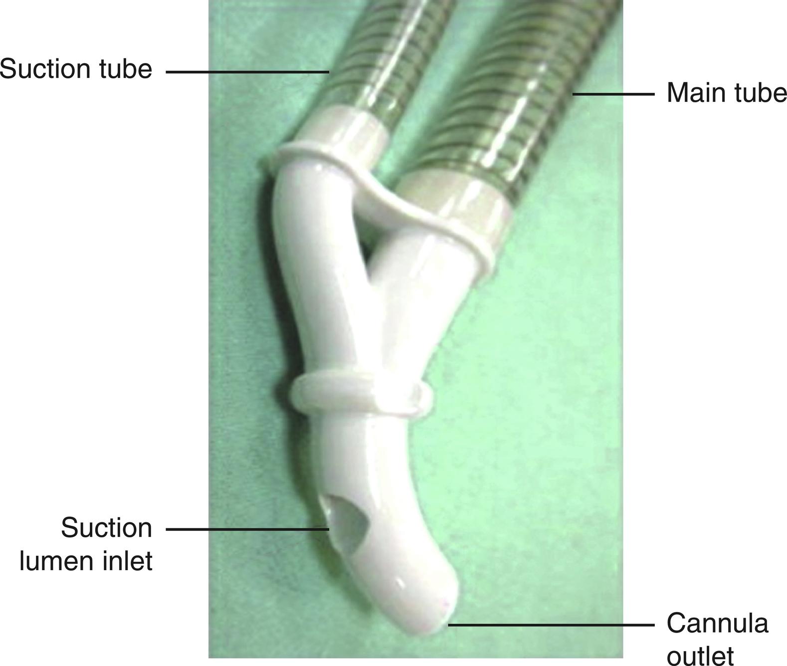 Fig. 22.1, CardioGard backward suction cannula.