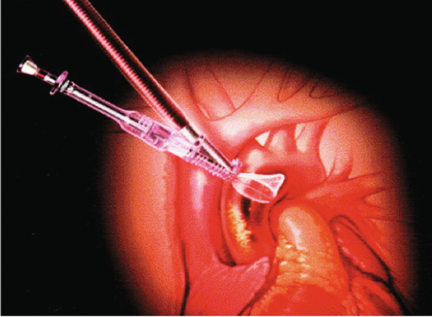 Fig. 22.2, Embol-X intra-aortic filtration device.