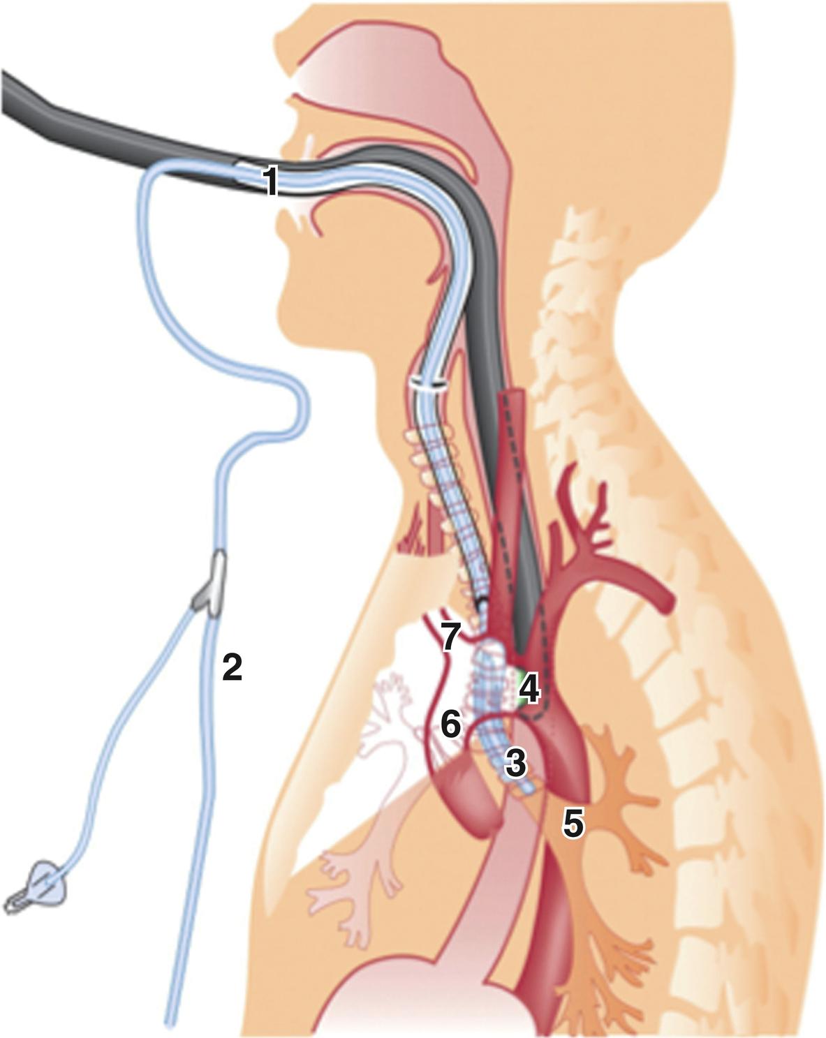 Fig. 22.3, A-View balloon catheter. 1 , endotracheal tube; 2 , A-View catheter; 3 , balloon of A-View catheter; 4 , transesophageal probe; 5 , left main bronchus; 6 , ascending aorta; 7 , innominate artery.