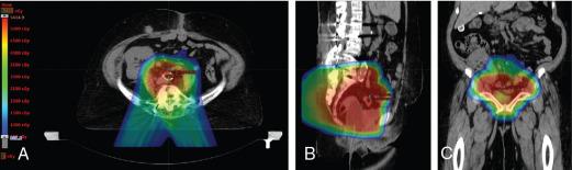 Fig. 11.1, Axial (A), sagittal (B), and coronal (C) color-wash views of a proton therapy treatment plan for a patient with FIGO (Fédération Internationale de Gynécologie et d’Obstétrique) stage IIB cervical carcinoma who underwent radical hysterectomy and required postoperative radiotherapy. She had a history of renal failure s/p kidney transplantation. Given the location of her pelvic kidney, proton therapy was used to reduce the dose to that kidney. (D) Dose volume histogram of her kidney (orange) , small bowel (blue) , bladder (yellow) , rectum (brown) , planning target volume (red) , and clinical target volume (green) are shown.