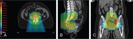 Fig. 11.2, Axial (A), sagittal (B), and coronal (C) color-wash views of a proton therapy treatment plan of a patient with FIGO (Fédération Internationale de Gynécologie et d’Obstétrique) stage IIIB cervical cancer with positive pelvic nodes. She was treated with pencil beam scanning proton therapy followed by brachytherapy and a nodal boost.