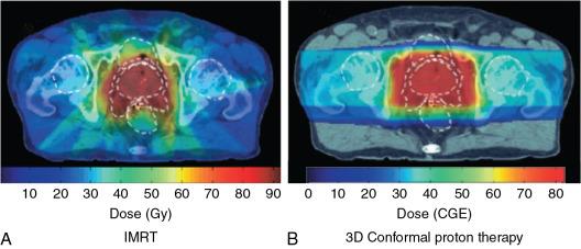 Fig. 12.2, Prostate treatment with protons versus intensity-modulated radiation therapy (IMRT). 3D , Three-dimensional; CGE , cobalt Gy equivalent.