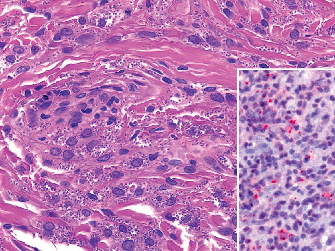 Fig. 83.12, Histopathology of leishmaniasis.