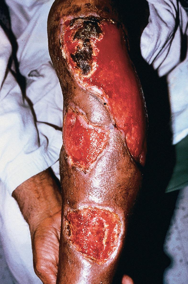 Fig. 83.13, Cutaneous amebiasis.