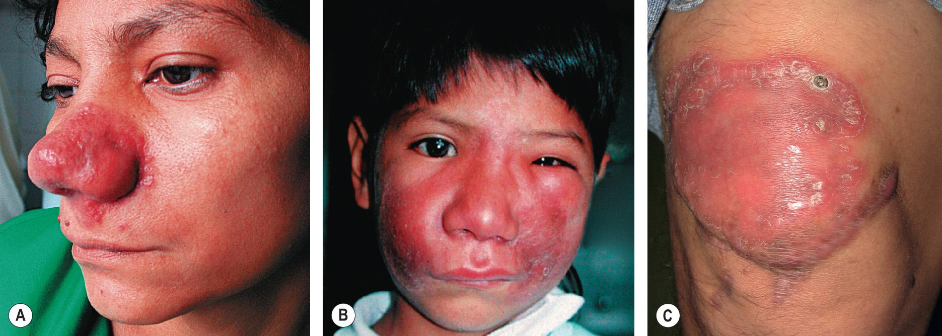 Fig. 83.14, Balamuthia mandrillaris infection.