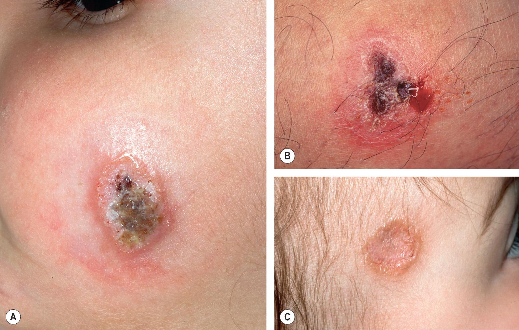 Fig. 83.4, Variable presentations of cutaneous leishmaniasis.