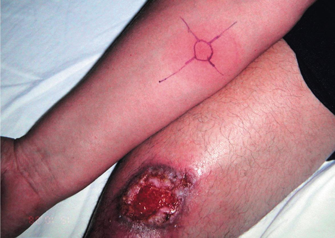 Fig. 83.5, Ulcerative cutaneous leishmaniasis on the leg and a positive Montenegro test.