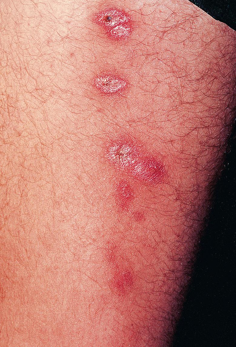 Fig. 83.6, Sporotrichoid form of cutaneous leishmaniasis.