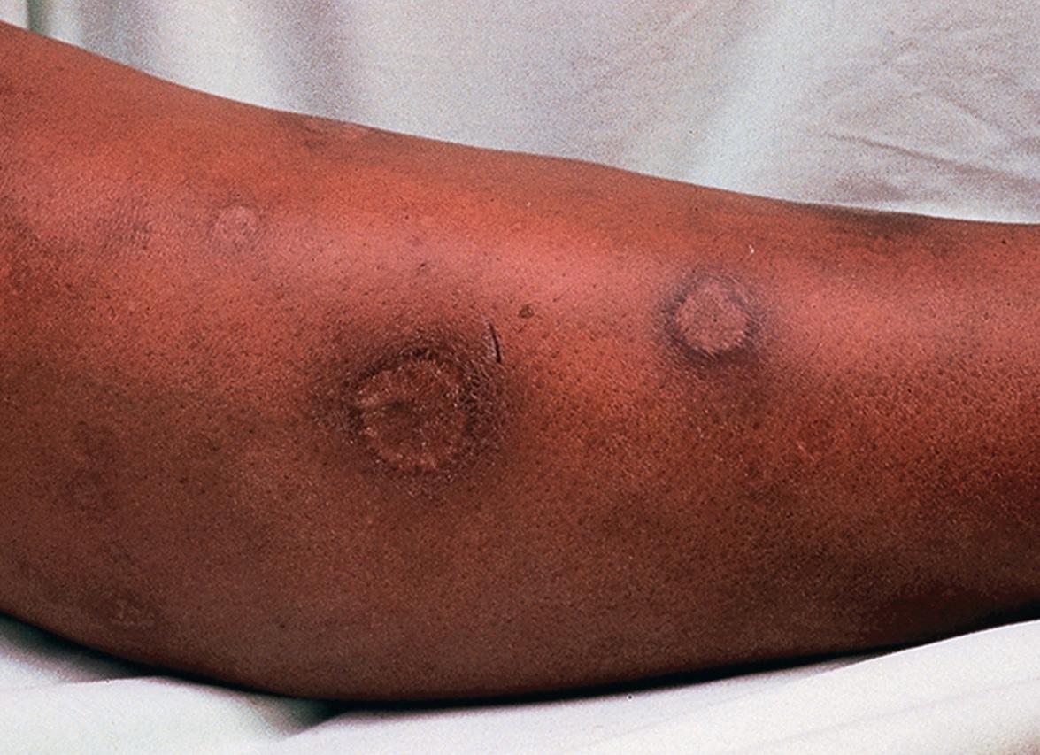 Fig. 83.7, Scars secondary to previous cutaneous leishmaniasis.