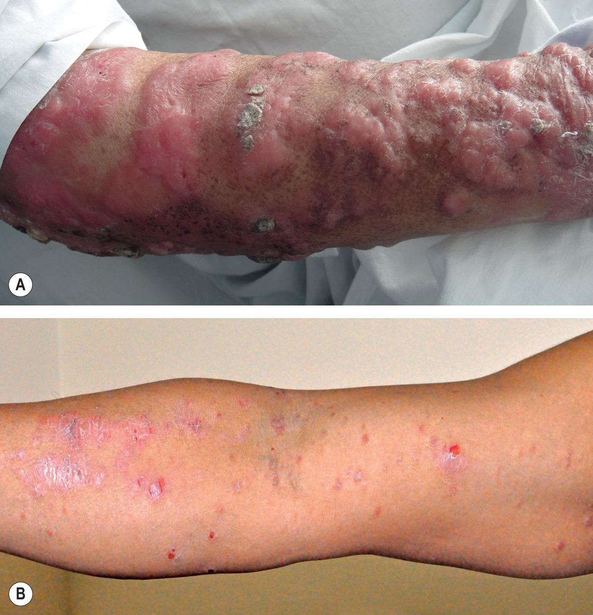 Fig. 83.8, Diffuse and disseminated cutaneous leishmaniasis.