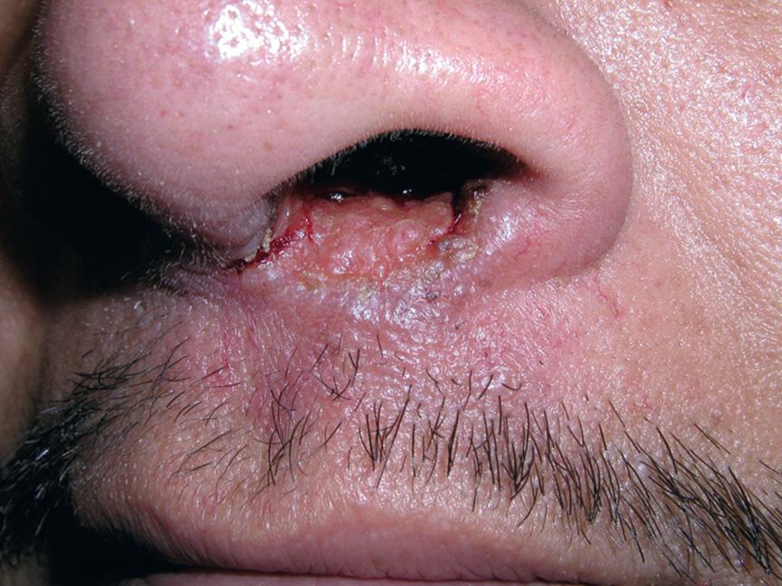 Fig. 83.10, Mucocutaneous leishmaniasis due to Leishmania braziliensis .