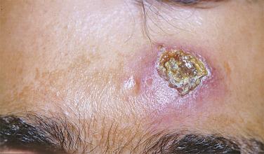 FIGURE 34-1, Cutaneous leishmaniasis. Crust on an indurated base.