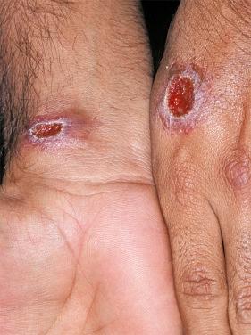 FIGURE 34-2, Cutaneous leishmaniasis.