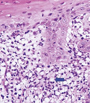 FIGURE 34-4, In tissue, the amastigote form of leishmaniasis is commonly seen at the periphery of intracytoplasmic vacuoles ( movie marquee sign ).