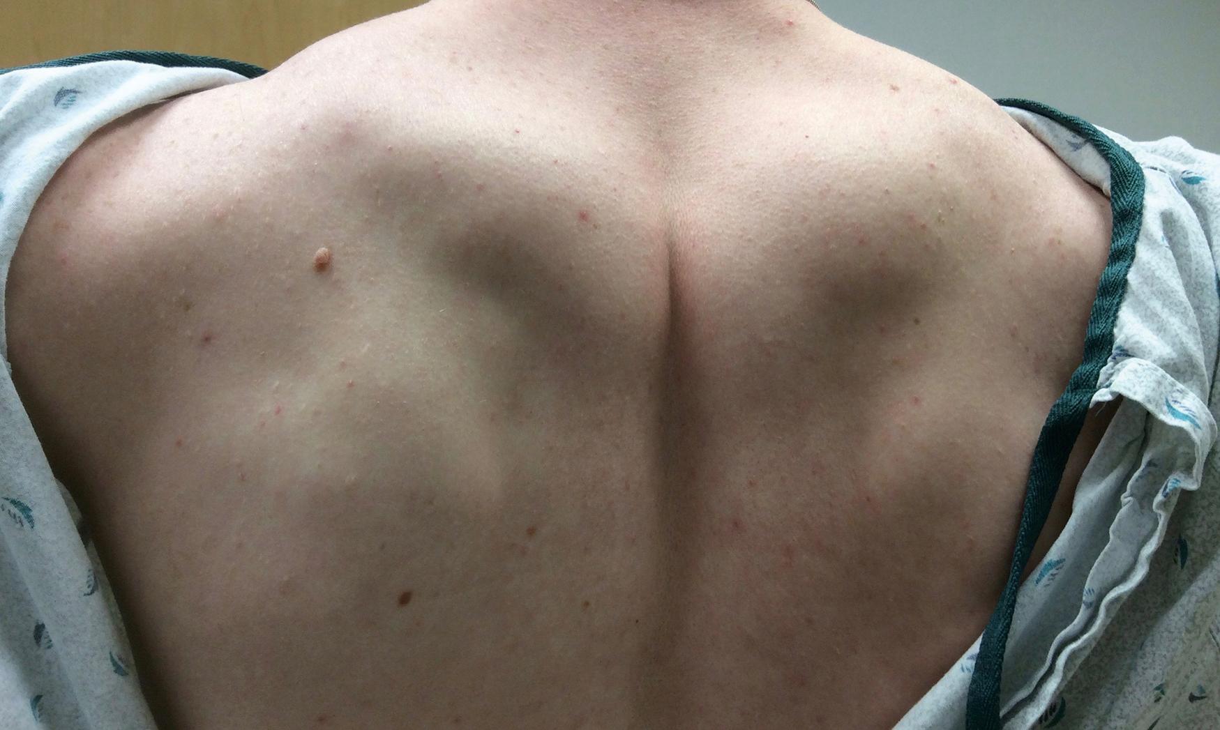 Fig. 28.2, Hypertrophy of shoulder and posterior neck muscles in a 20-year-old male with myotonia since childhood.