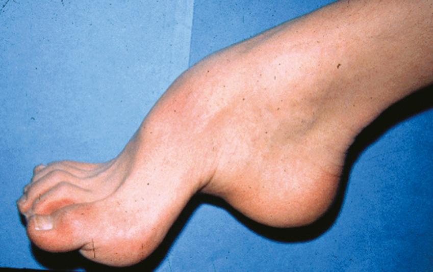 Fig. 28.3, Pes cavus is caused by intrinsic foot muscle weakness during early growth and development. This condition is recognized as a high arch, foreshortened foot, and hammer toes. It often is a sign that weakness has been present since early childhood and implies an inherited disorder in most patients.