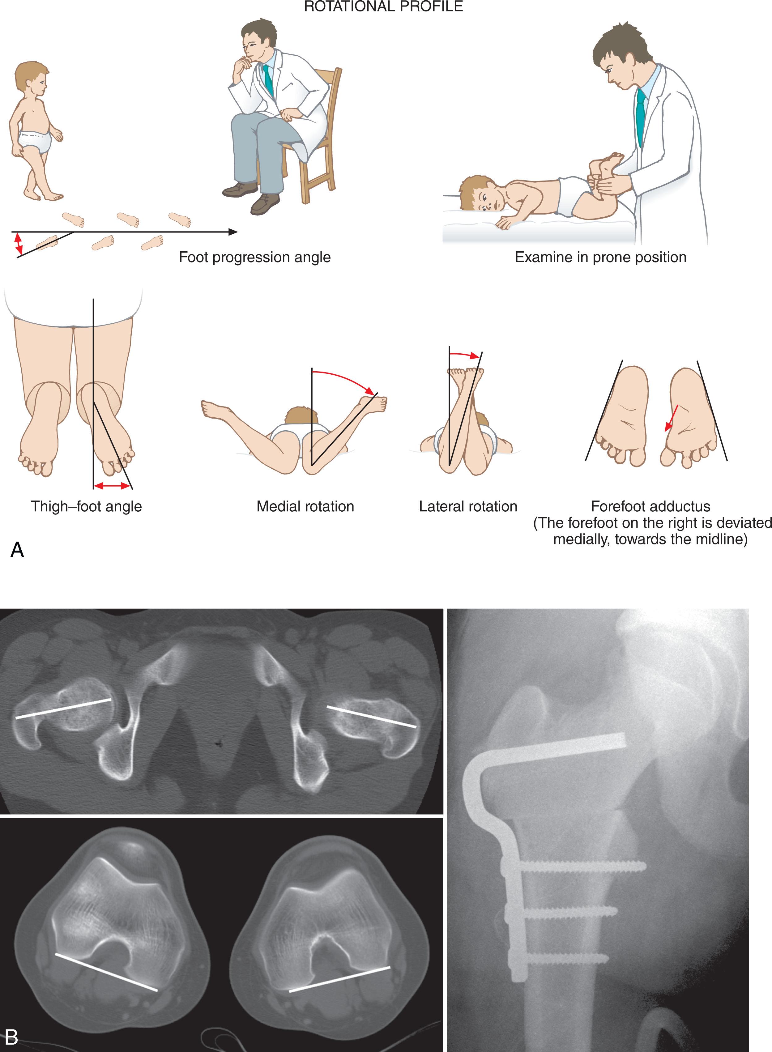 Fig. 29.1, Rotational Imaging Profile: Computed Tomography Scanogram. (A) Femoral version. Adapted from Staheli LT (ed). Pediatric Orthopaedic Secrets, 2nd edn. Hanley and Belfus, Philadelphia; 2003 (B) Knee version (numerous described techniques without a gold standard; the authors recommending selecting one method, such as transcondylar axis, and remaining consistent). Congenital and developmental conditions. In May, D.A., Morrison, W.B., Belair, J.A. (2022) Musculoskeletal Imaging: The Core Requisites, 5th edition. (C) Example of preoperative templating for angular deformity correction. Congenital and Developmental Abnormalities of the hip and Pelvis. In Azar, F.M., Canale, S.T., Beaty, J.H. (2021) Campbell’s Operative Orthopaedics, 14th edition.