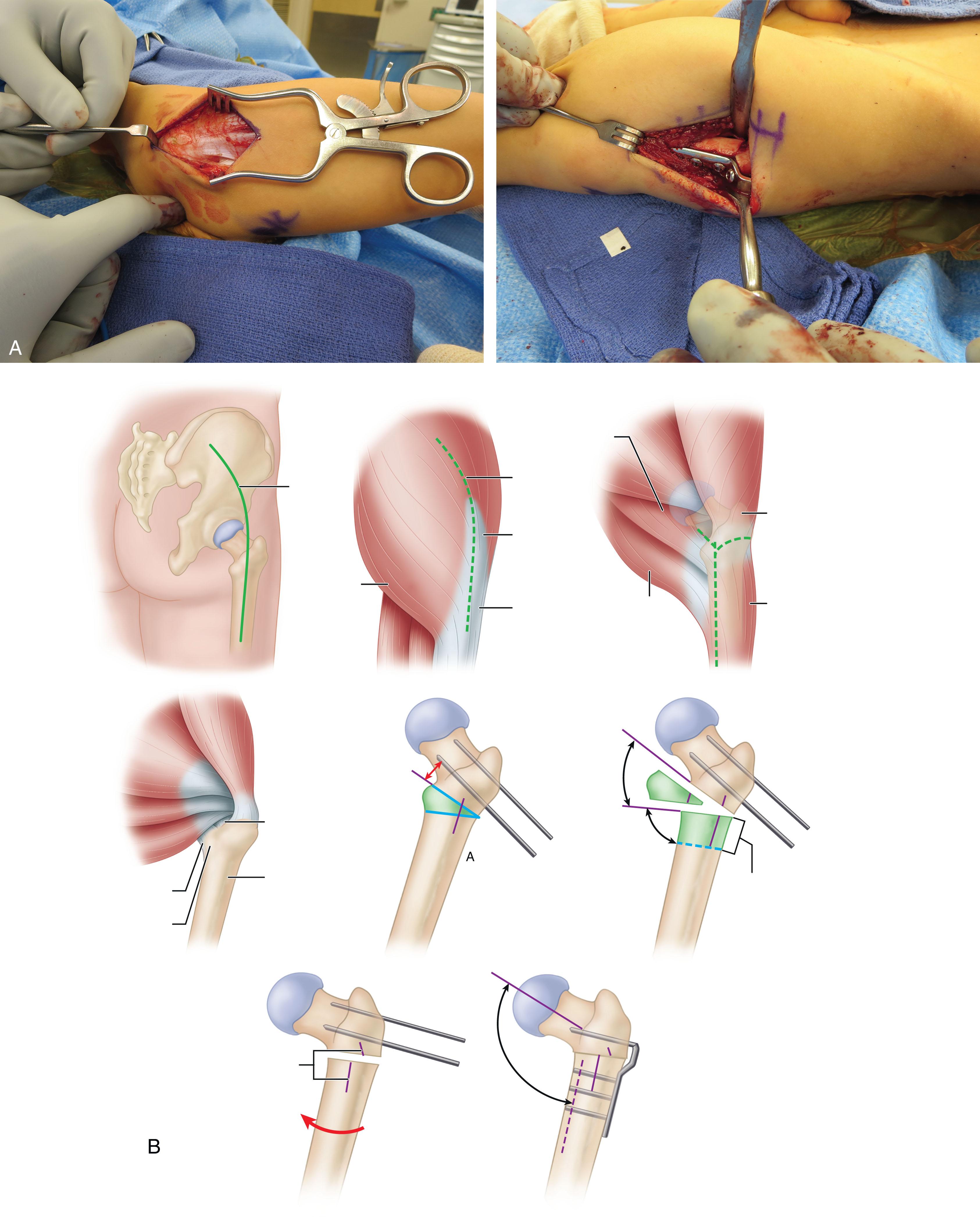 Fig. 29.2, Example of Surgical Technique. (A) Superficial dissection of a lateral approach, with iliotibial band and subvastus ridge event. (B) Example of varus osteotomy. Cerebral Palsy. In Azar, F.M., Canale, S.T., Beaty, J.H. (2021) Campbell’s Operative Orthopaedics, 14th edition.