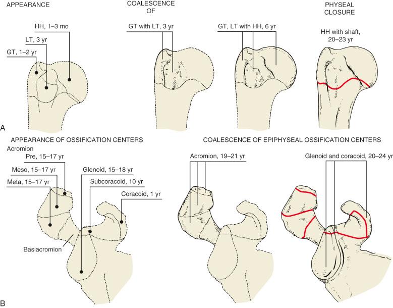 Fig. 47.1, Appearance and closure of ossification centers about the glenohumeral joint. (A) Proximal end of the humerus. (B) Acromion, coracoid, and glenoid. The basiacromion was present at birth. GT, Greater tuberosity; HH, humeral head articular segment; LT, lesser tuberosity; Meso, mesoacromion; Meta, meta-acromion; Pre, preacromial epiphysis.