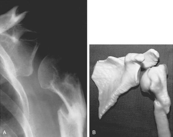 Fig. 47.12, Three-part fracture with malunion of the greater tuberosity and loss of humeral length. (A) Anterior-posterior radiograph showing varus malunion. (B) Three-dimensional reconstruction confirms varus malunion through the upper part of the shaft, inferior subluxation of the humeral head, and poor position of the greater tuberosity directly over the humeral shaft. Late prosthetic reconstruction required biplanar osteotomy of the greater tuberosity and repositioning lower than the articular surface and more laterally.