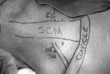 Fig. 47.13, Superficial anatomic landmarks for an interscalene nerve block. C6, Sixth cervical level; EXT JUG, external jugular vein; SCM, sternocleidomastoid.