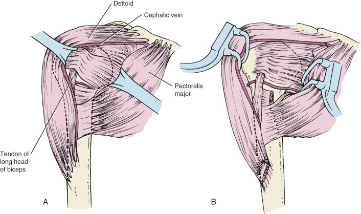 Fig. 47.15, The deltopectoral approach preserves the cephalic vein. The coracoid is left intact to protect the brachial plexus. Richardson retractors (A) or self-retaining Balfour retractors (B) maintain exposure to the proximal end of the humerus.