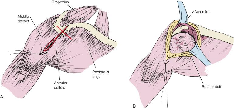 Fig. 47.16, (A) Superior approach with a deltoid split but without anterior acromioplasty. (B) Approach for anterior acromioplasty. The skin incision follows the Langer skin lines over the top of the acromion and perpendicular to the deltoid split.