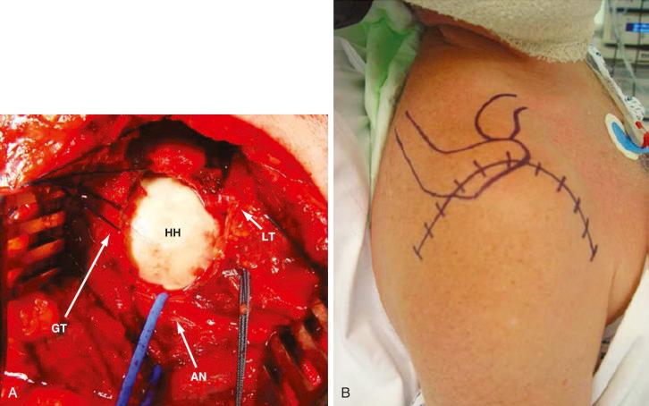 Fig. 47.17, (A) Extended deltoid-splitting approach on a right shoulder. AN, Axillary nerve; GT, greater tuberosity; HH, humeral head. (B) Skin incision for extended deltoid-splitting approach marked on a right shoulder.