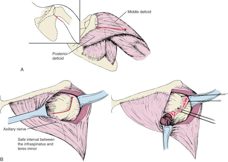 Fig. 47.18, (A and B) Posterior approach to a right shoulder.