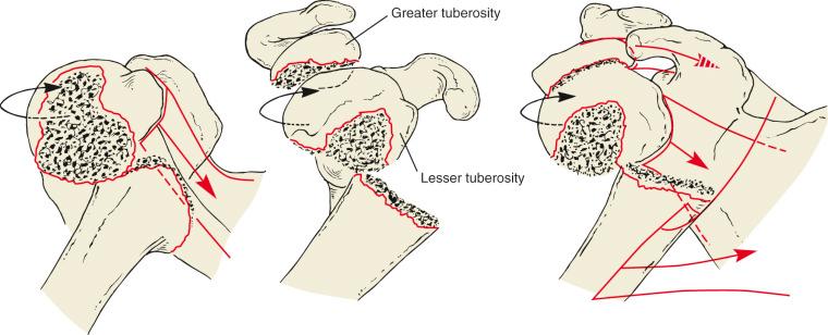 Fig. 47.19, Three-part greater tuberosity fracture. The pectoralis displaces the unimpacted shaft anteriorly and medially. The greater tuberosity is retracted by the spinatus and teres minor muscles. The articular segment is rotated posteriorly by the intact subscapularis. Arrows indicate the direction of tuberosity displacement with muscle pull.