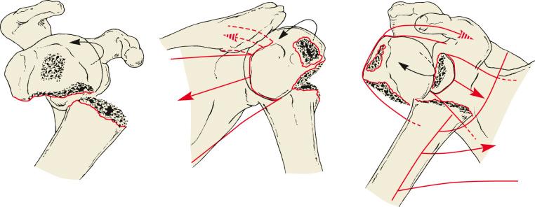 Fig. 47.20, Three-part lesser tuberosity fracture. The intact spinatus and teres minor muscles attaching to the greater tuberosity rotate the articular segment anteriorly. The avulsed lesser tuberosity is pulled medially by the subscapularis muscle. Arrows indicate the direction of tuberosity displacement with muscle pull.