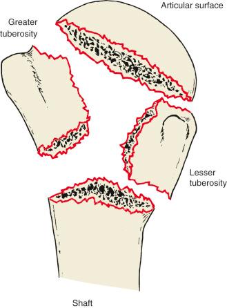 Fig. 47.2, Codman's classification of four-segment proximal humeral fractures.