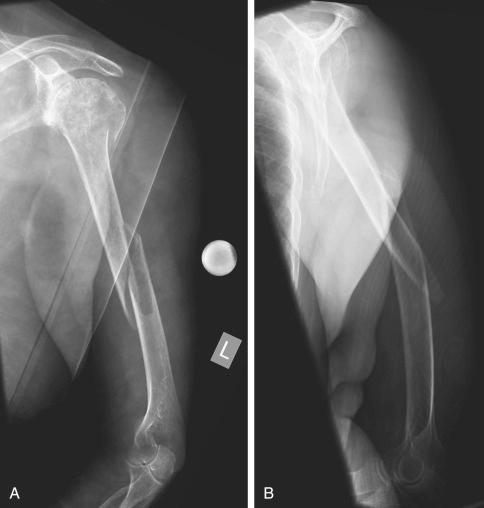 Fig. 47.22, (A) An 82-year-old woman with an oblique humerus shaft fracture. The fracture continues up to the proximal humerus with displacement of the greater tuberosity. (B) Lateral view.