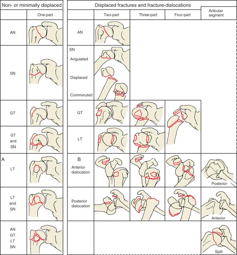 Fig. 47.24, Four-part classification for fractures and fracture-dislocations. AN, Anatomic neck; GT, greater tuberosity; LT, lesser tuberosity; SN, surgical neck.