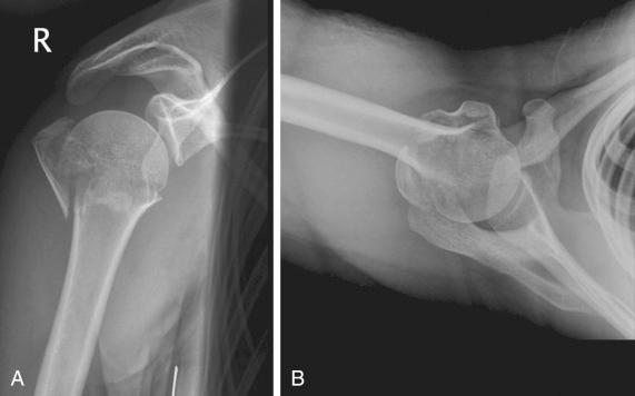 Fig. 47.25, Anterior-posterior (A) and axial (B) views of a 55-year-old man with a typical valgus impacted three-part fracture.