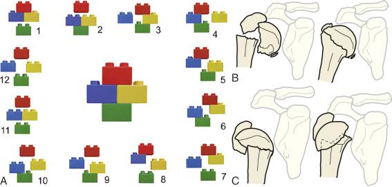 Fig. 47.27, (A) Binary (LEGO) description system with 12 basic fracture patterns ( red, head; yellow, lesser tuberosity; blue, greater tuberosity; green , shaft). (B) Length of the medial metaphyseal head extension. The longer the extension, the more likely the head is perfused. (C) Integrity of the medial hinge.