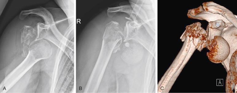 Fig. 47.28, (A) Anterior-posterior view of a right shoulder of a 47-year-old male. Greater tuberosity fracture-dislocation with obscure fracture of the head. (B and C) Iatrogenic displacement after a closed reduction attempt with severe displacement of the head fragment.