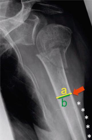 Fig. 47.30, The deltoid tuberosity index (DTI) is calculated just proximal to the deltoid tuberosity (asterices), where the outer cortical borders become parallel for the first time (red arrow). At this level, the outer cortical diameter (a, yellow line) is divided by the inner endosteal diameter (b, green line), resulting in a ratio that does not need to be corrected for the magnification error. DTI values of less than 1.4 have been found to correlate very well with low bone quality of the humeral head.